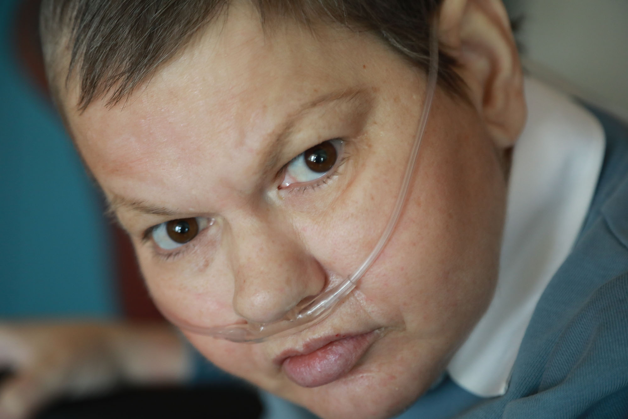 woman with oxygen tube in nostril looking in camera