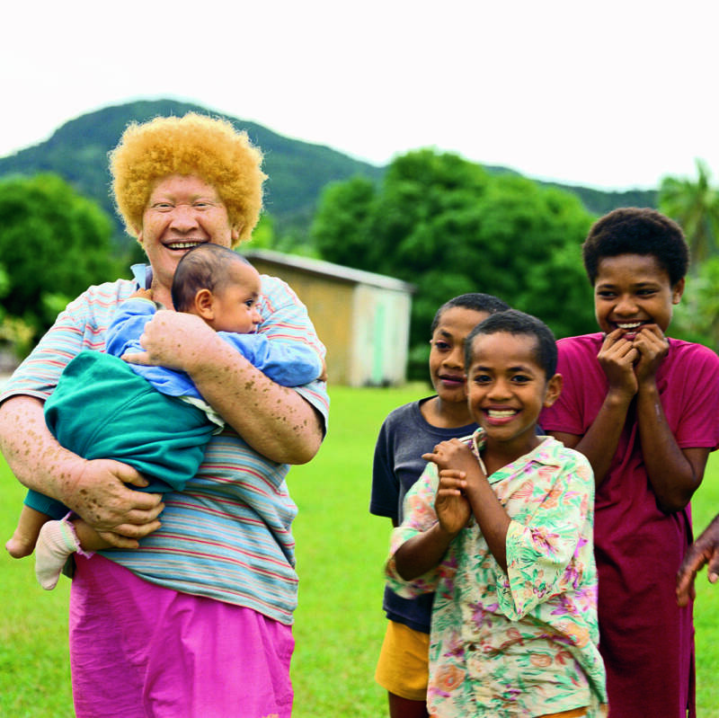 Albinism - Positive Exposure