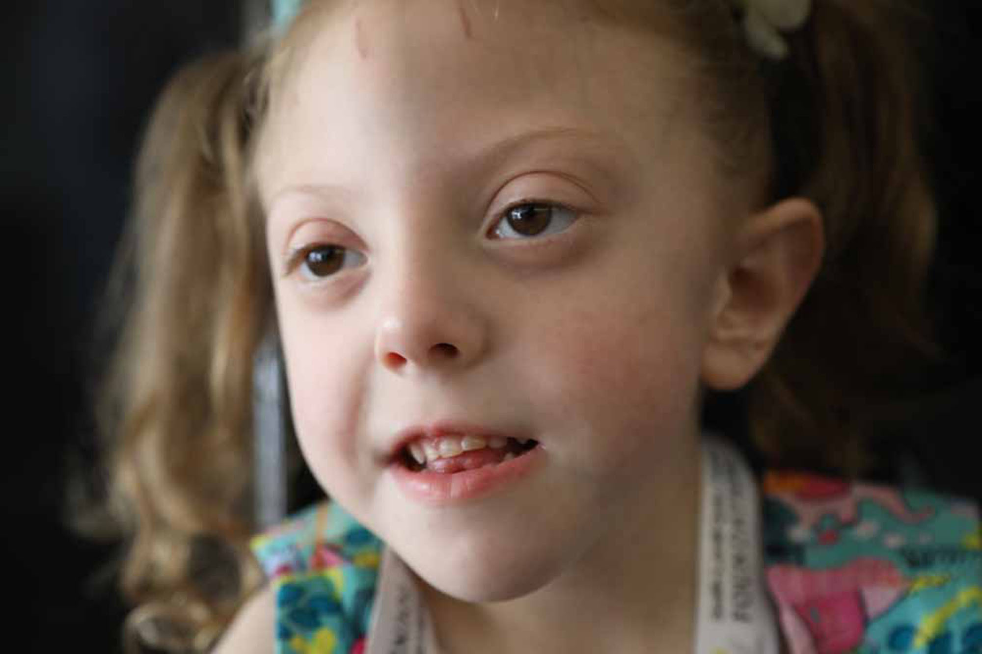 Smith Lemli Opitz 11