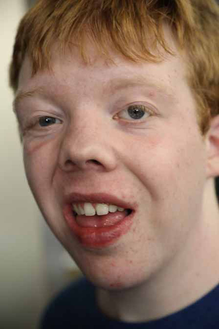 Smith Lemli Opitz 25