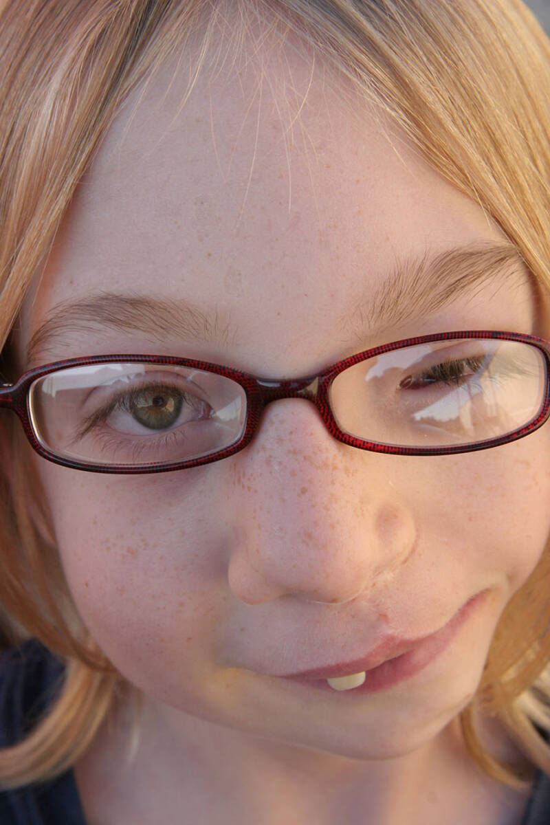 Goldenhar Syndrome - Positive Exposure