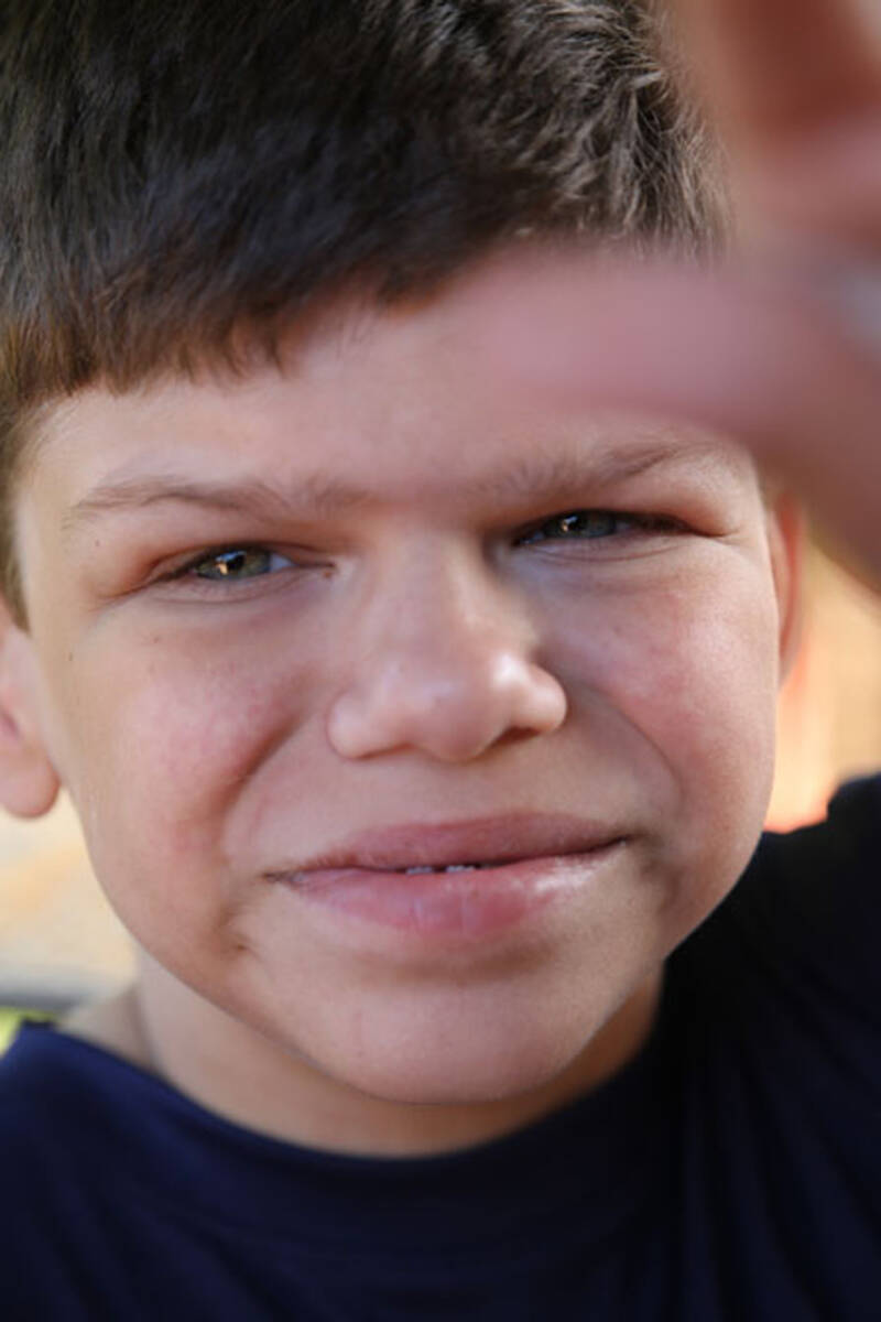 Williams Syndrome - Positive Exposure