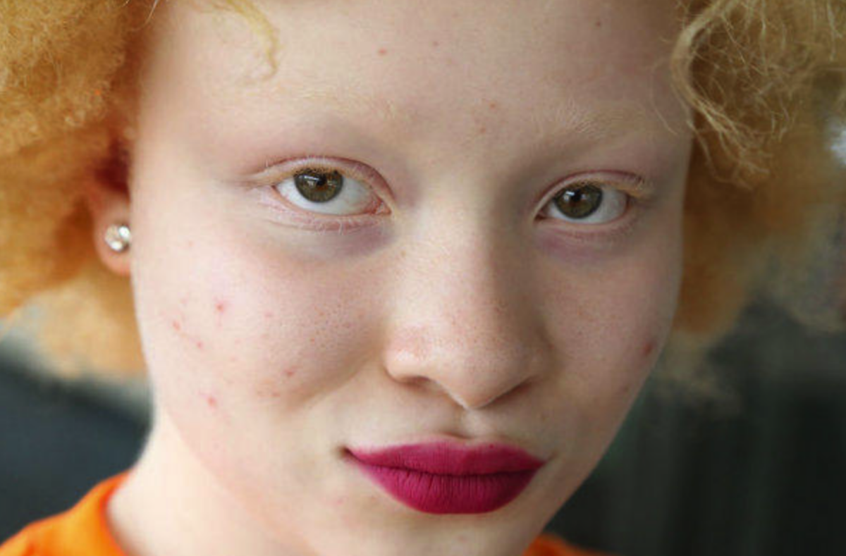 Albinism - Positive Exposure