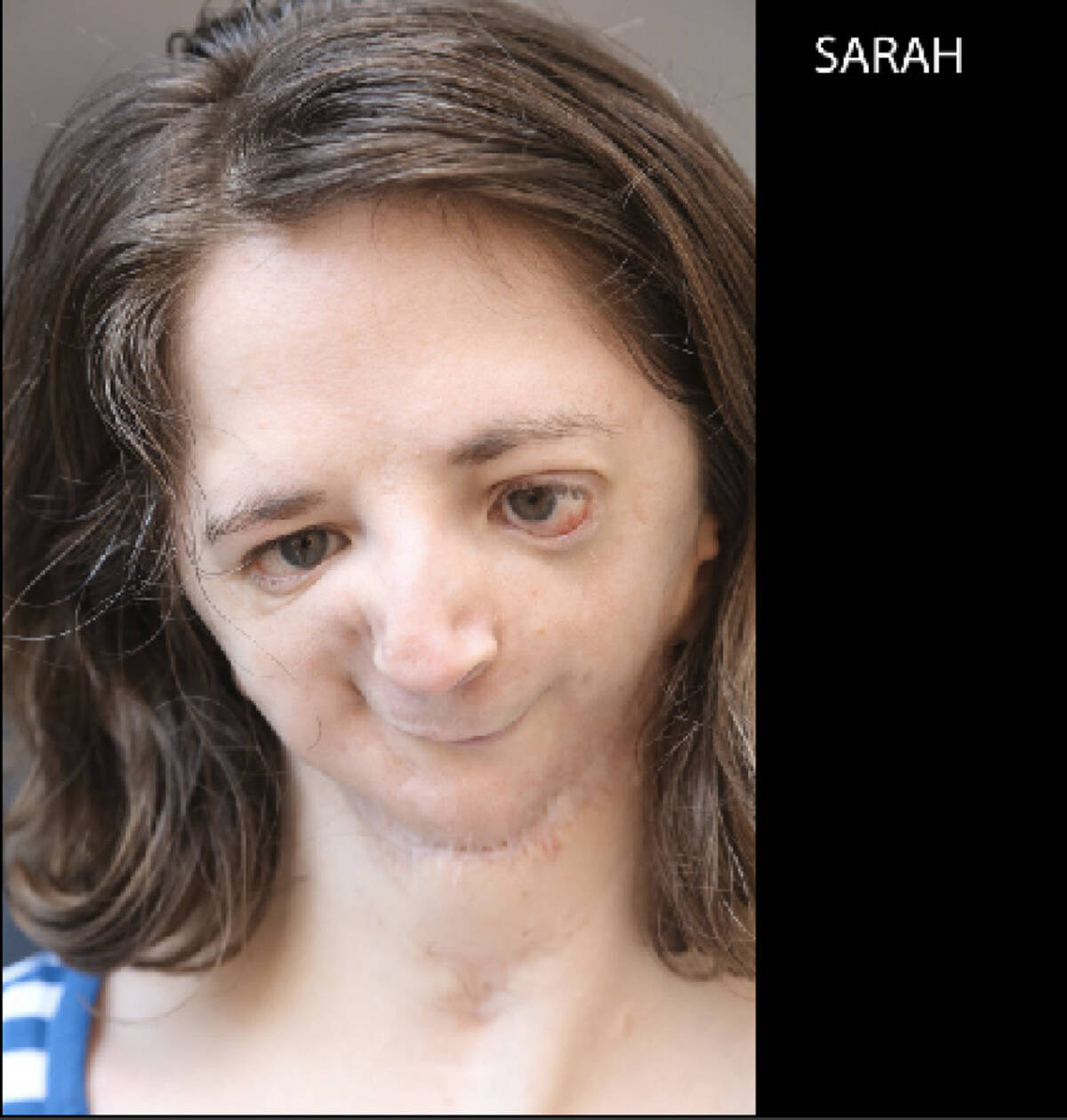 Nager Syndrome - Positive Exposure