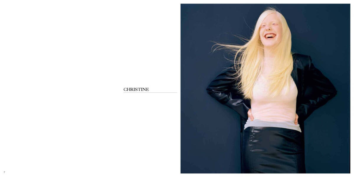 Albinism - Positive Exposure