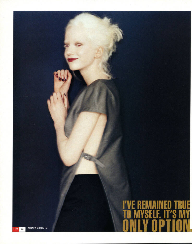 Albinism - Positive Exposure