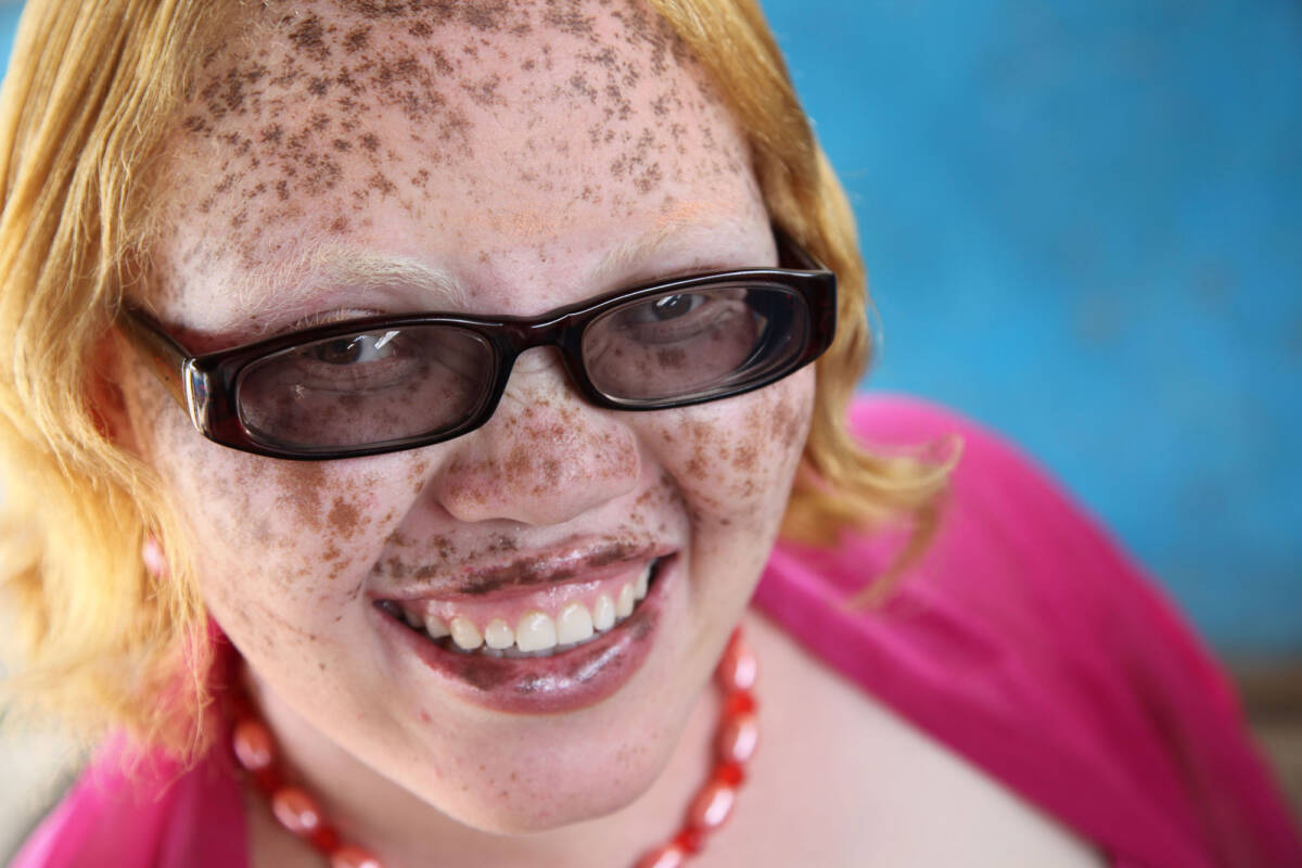 Albinism - Positive Exposure