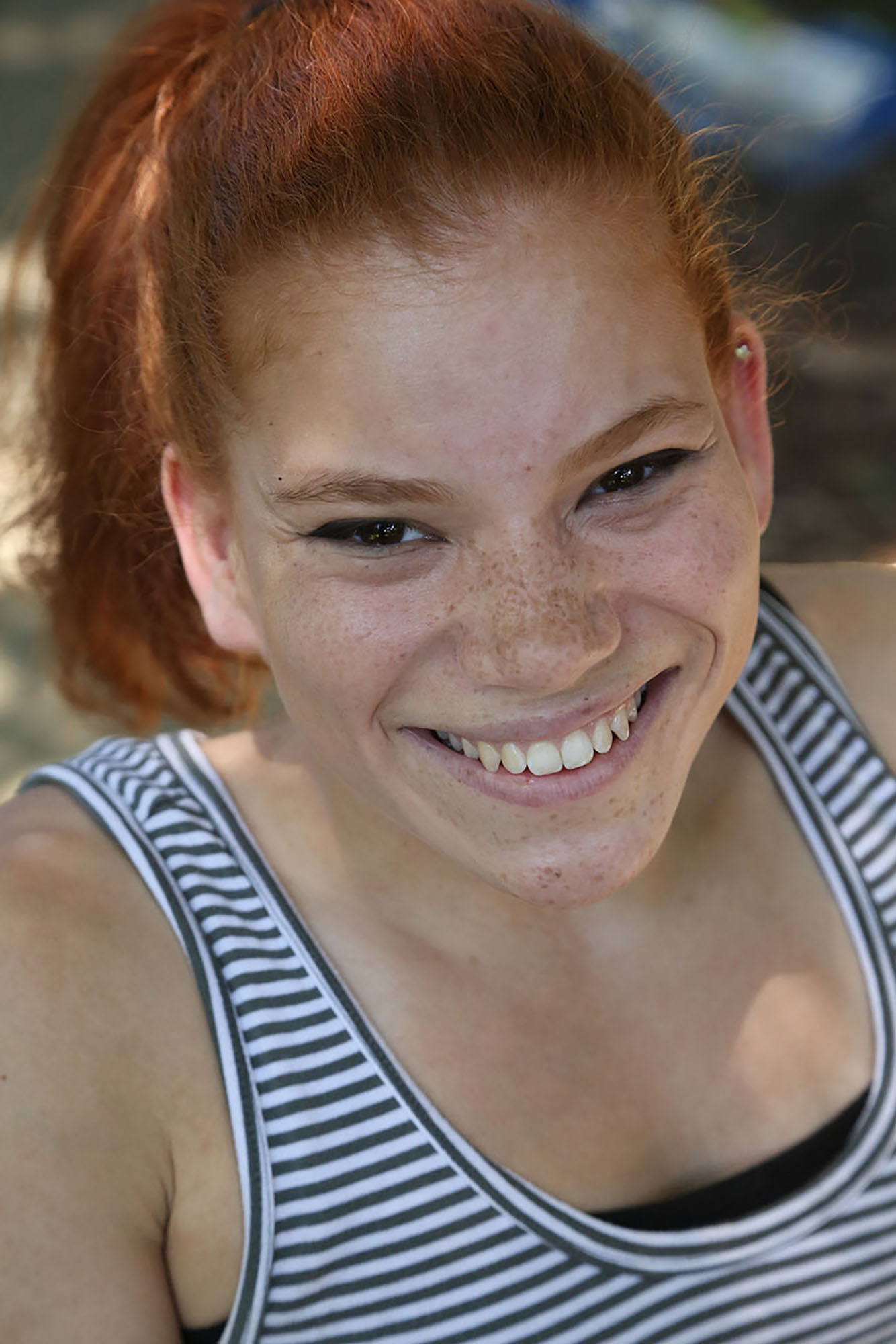 Woman with sacral agenesis caudal regression close up smiling