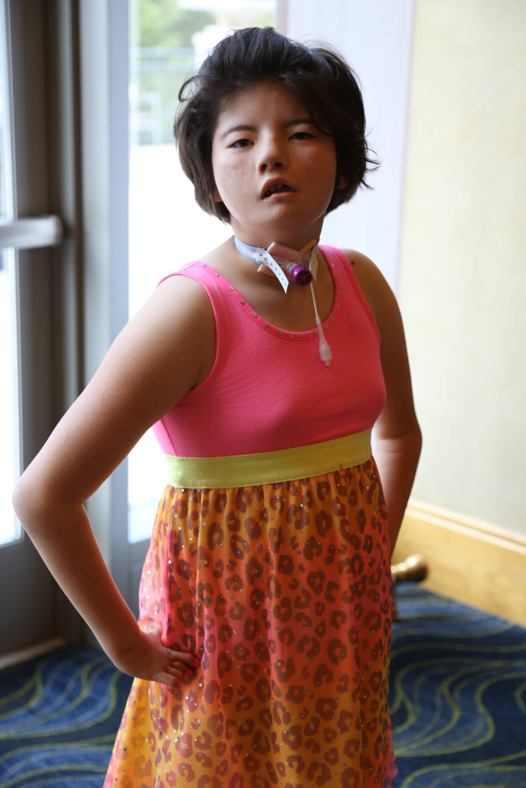 girl with Moebius syndrome wearing vibrant dress looks at camera