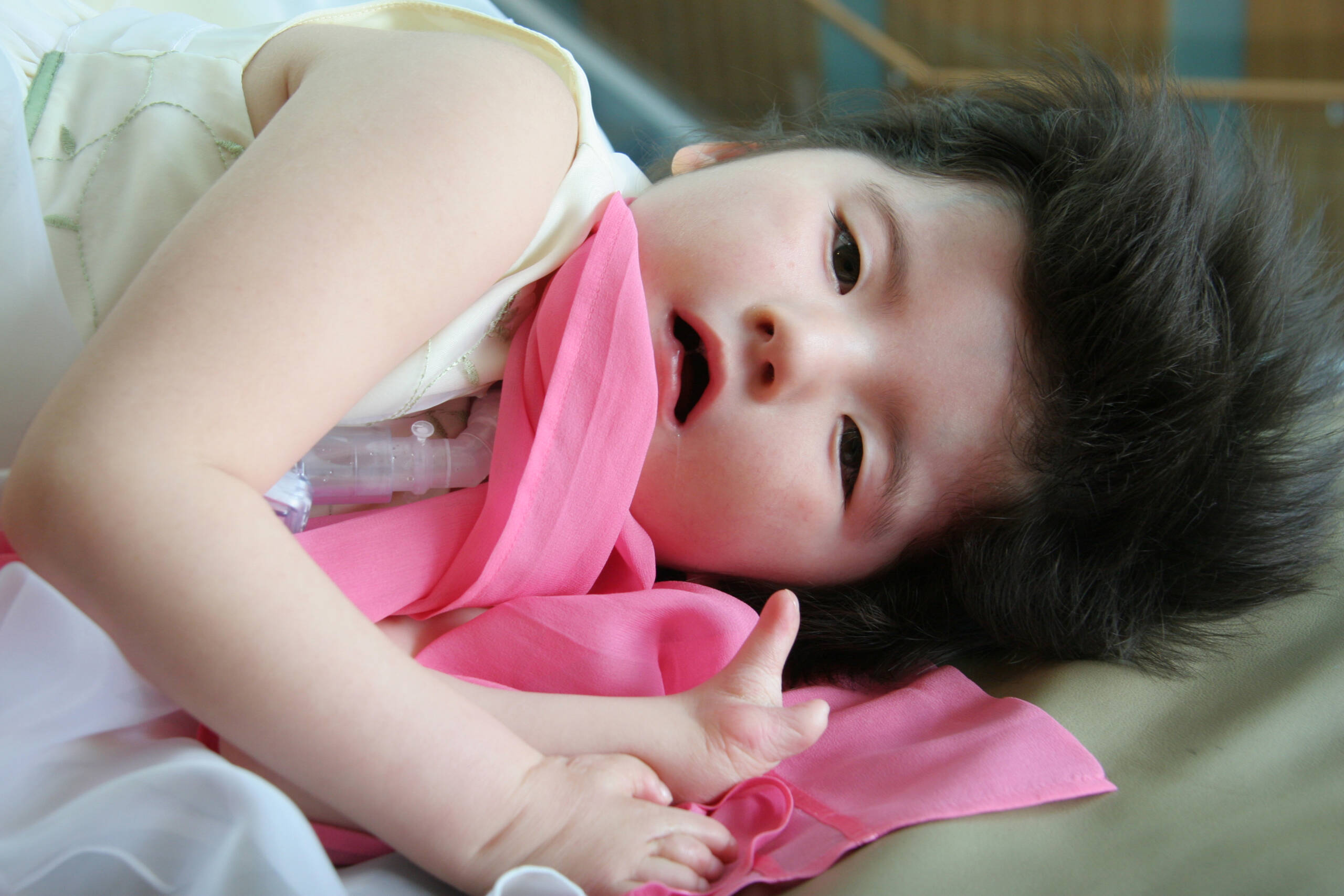 young girl with Moebius syndrome lying on her side, looking at camera