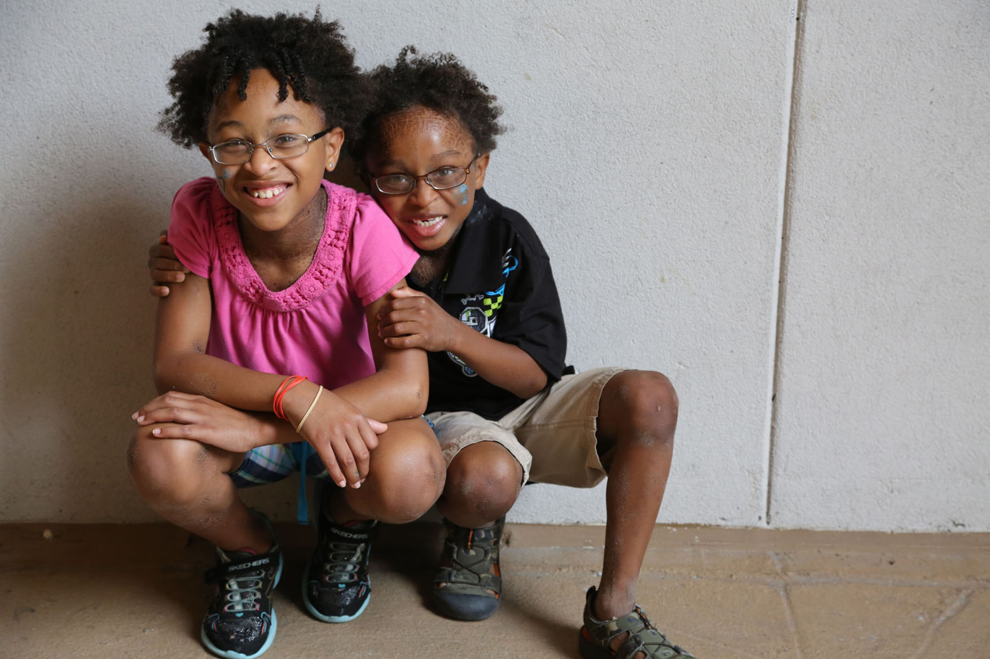 two siblings with Ichthyosis hugging eachother