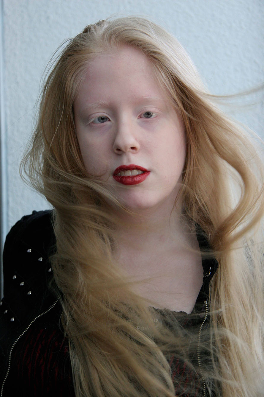 Woman with Hermansky-Pudlak syndrome looking into camera
