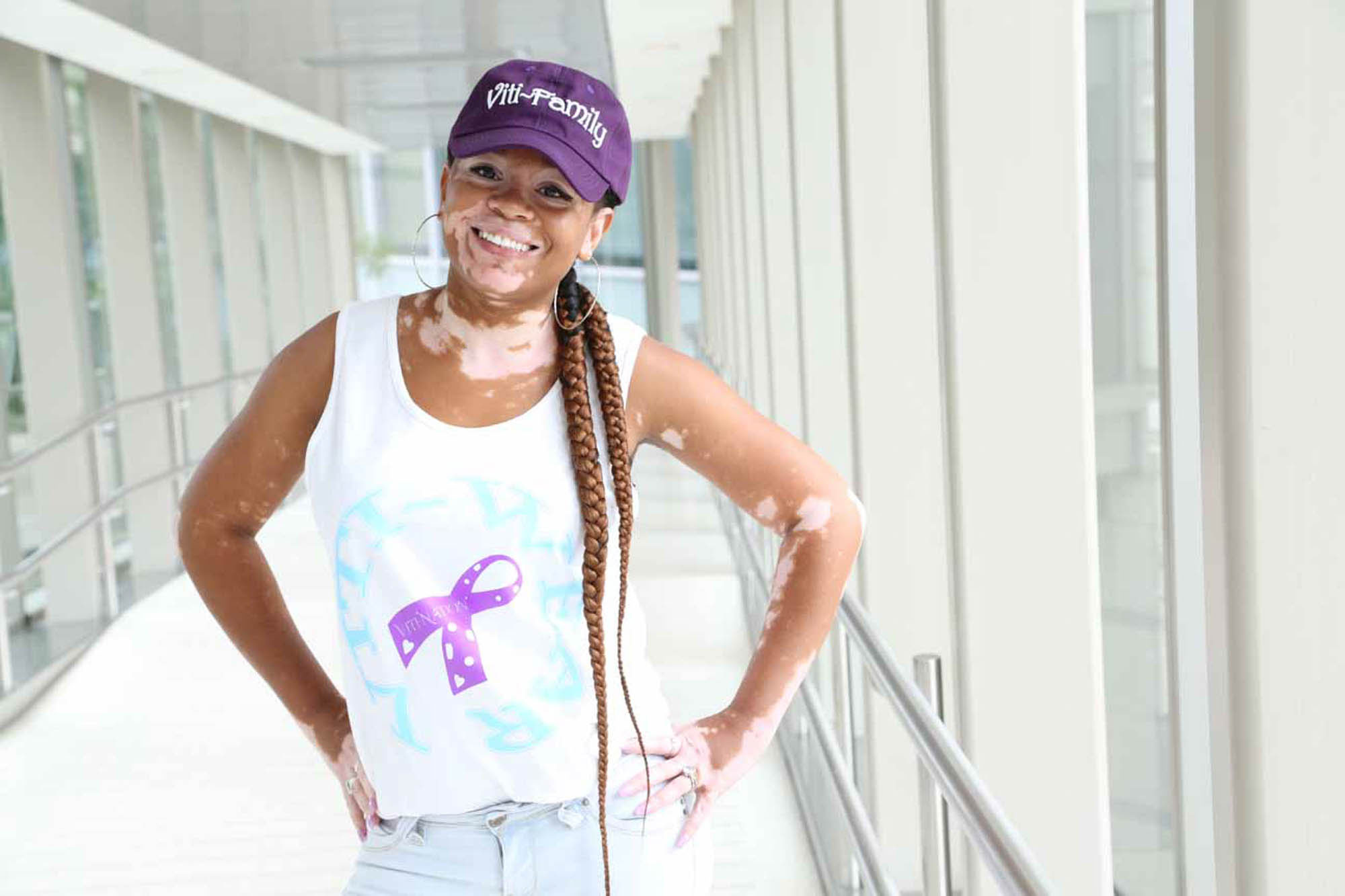 woman with Vitiligo smiling at the camera