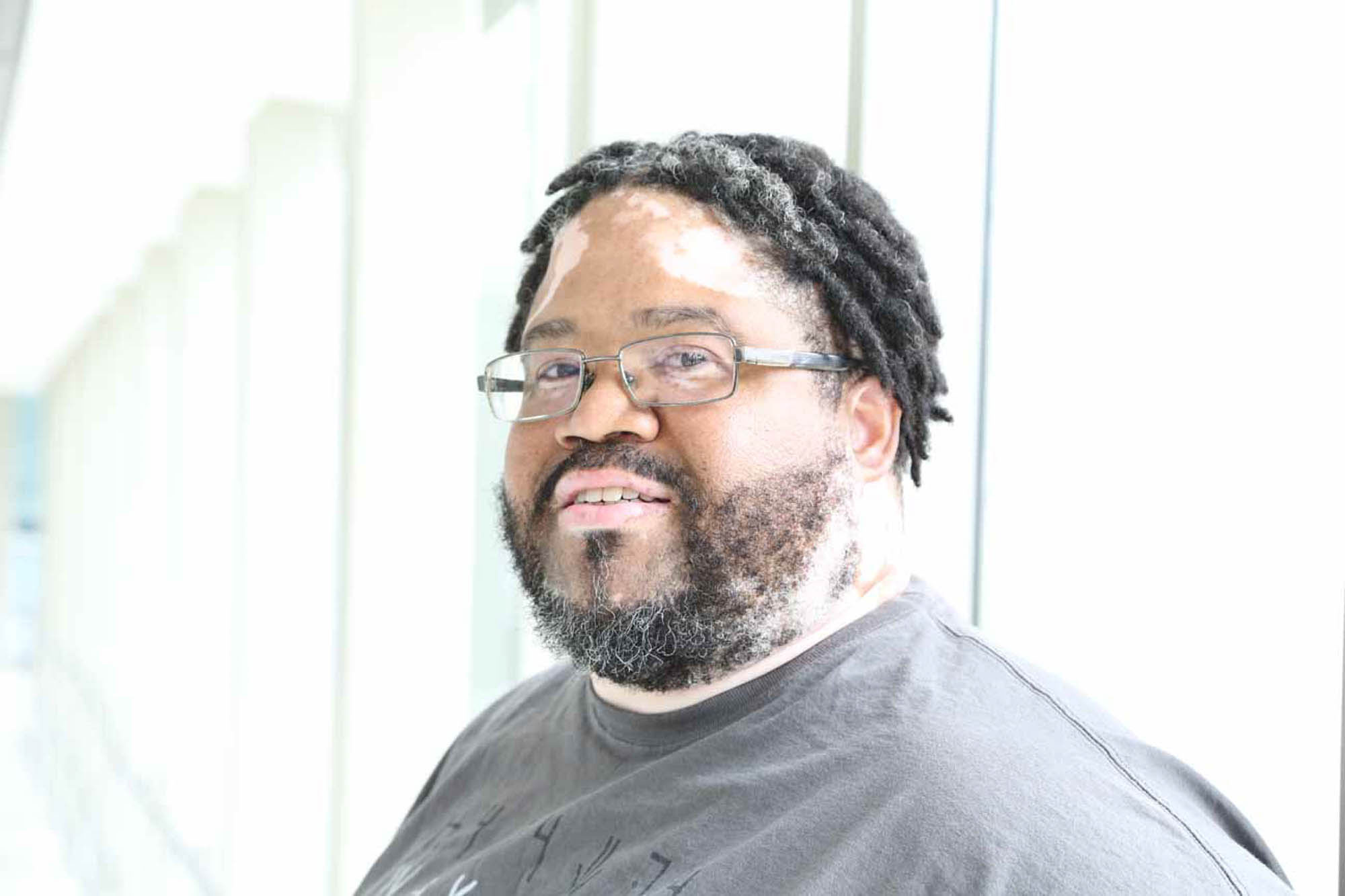 man with Vitiligo wearing glasses looking at the camera