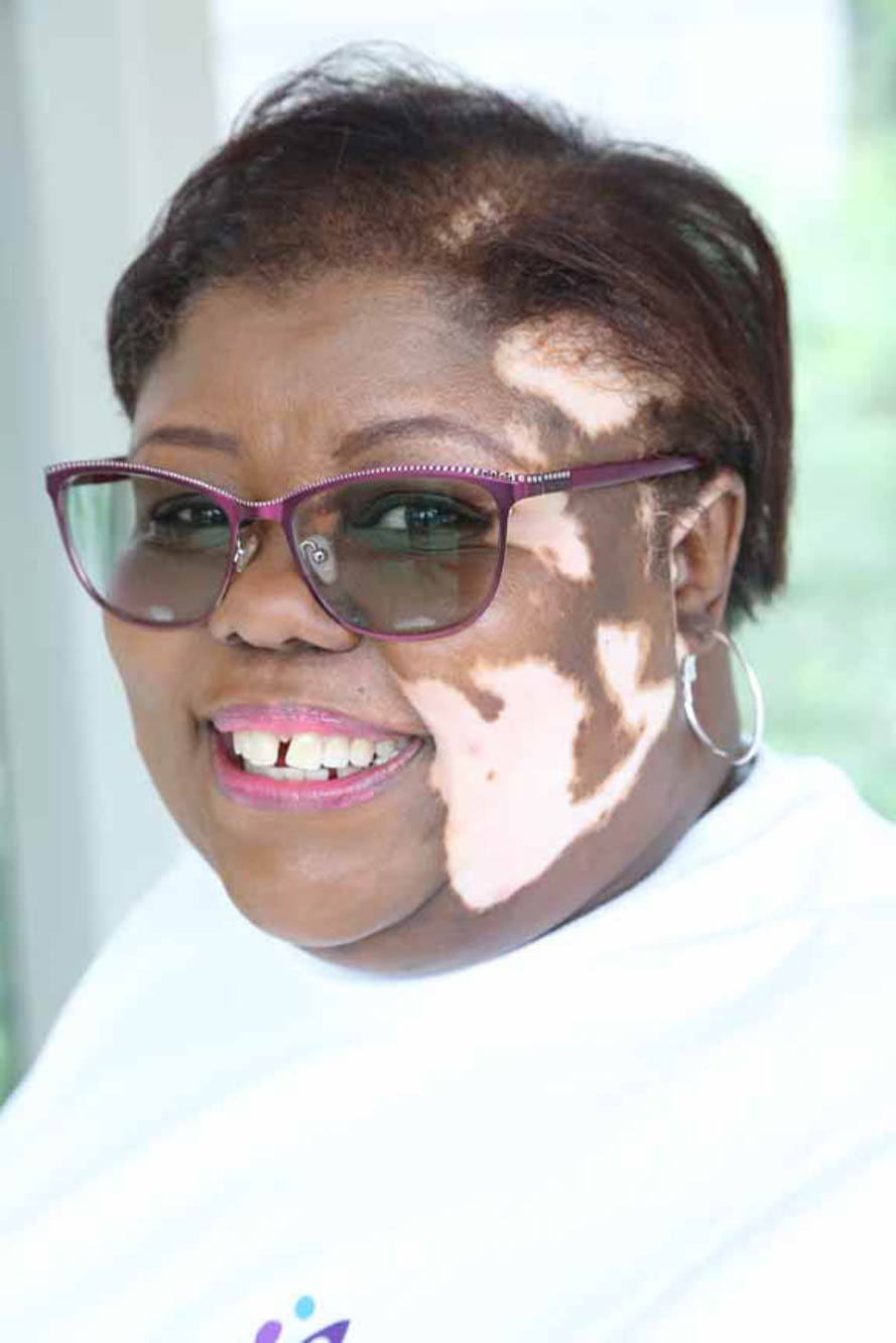 woman with Vitiligo smiling at the camera