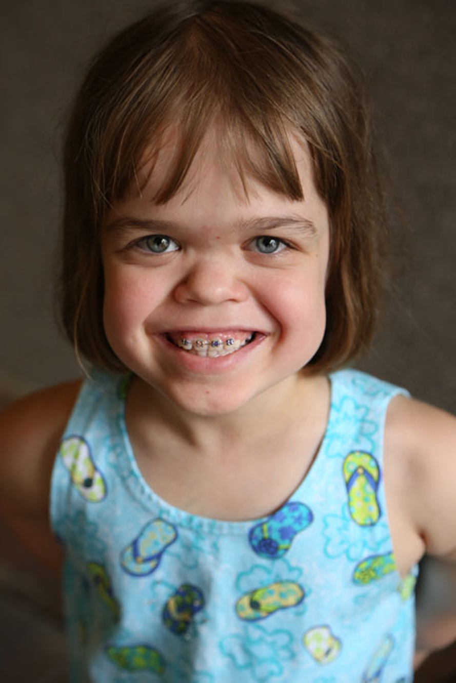 girl with skeletal dysplasia smiles at the camera