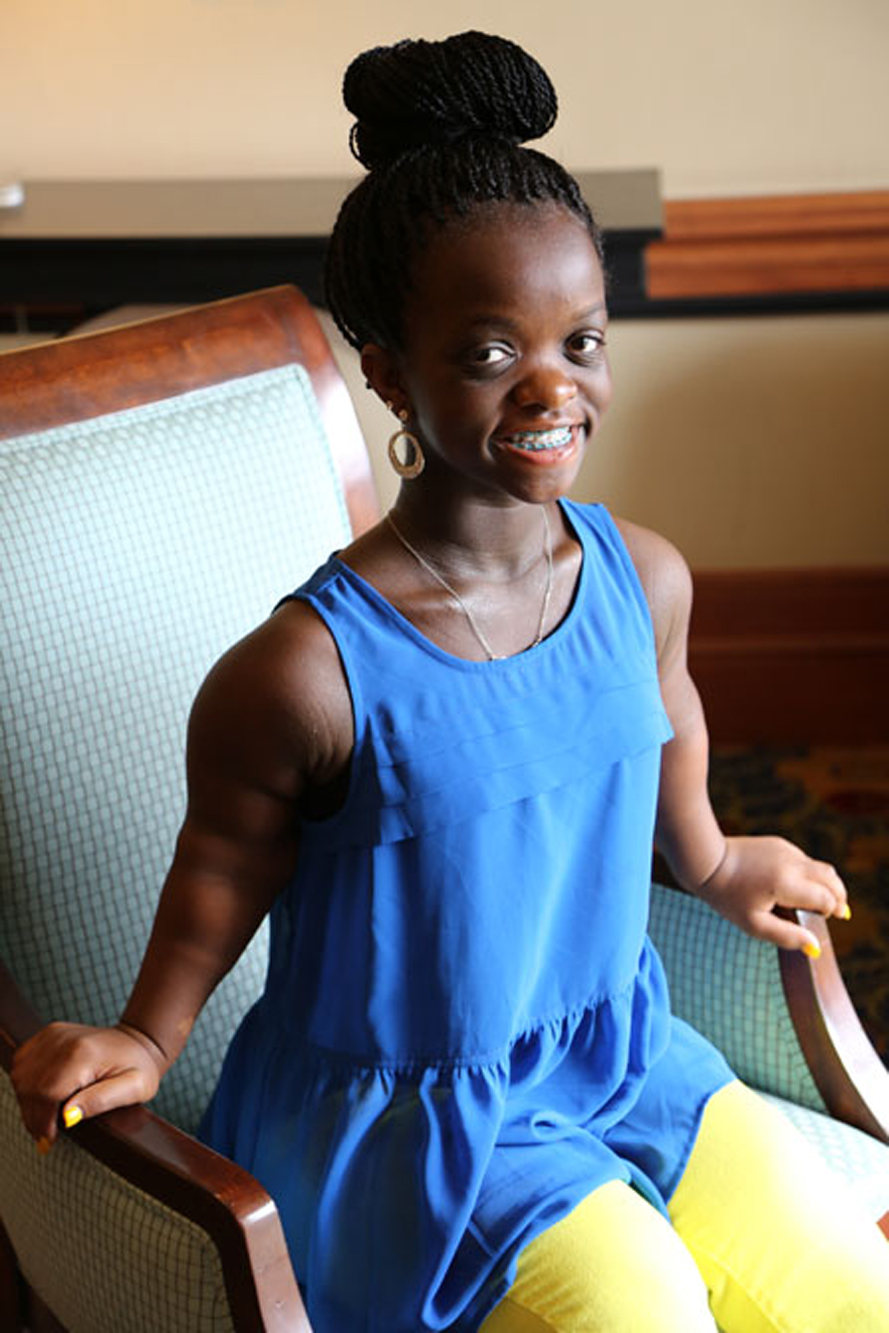 young woman with skeletal dysplasia sitting down looking at the camera
