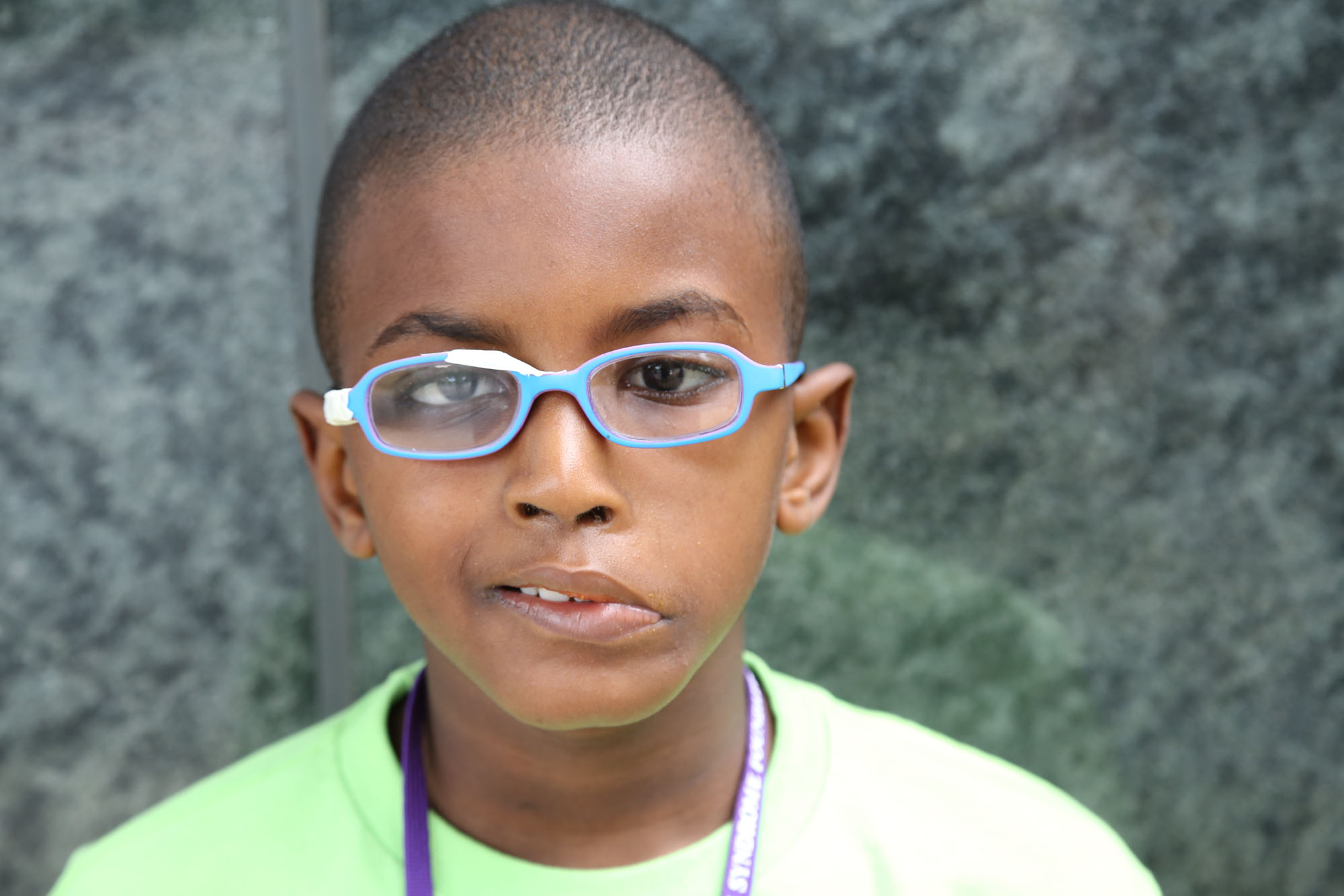young boy with moebius syndrome wearing blue glasses