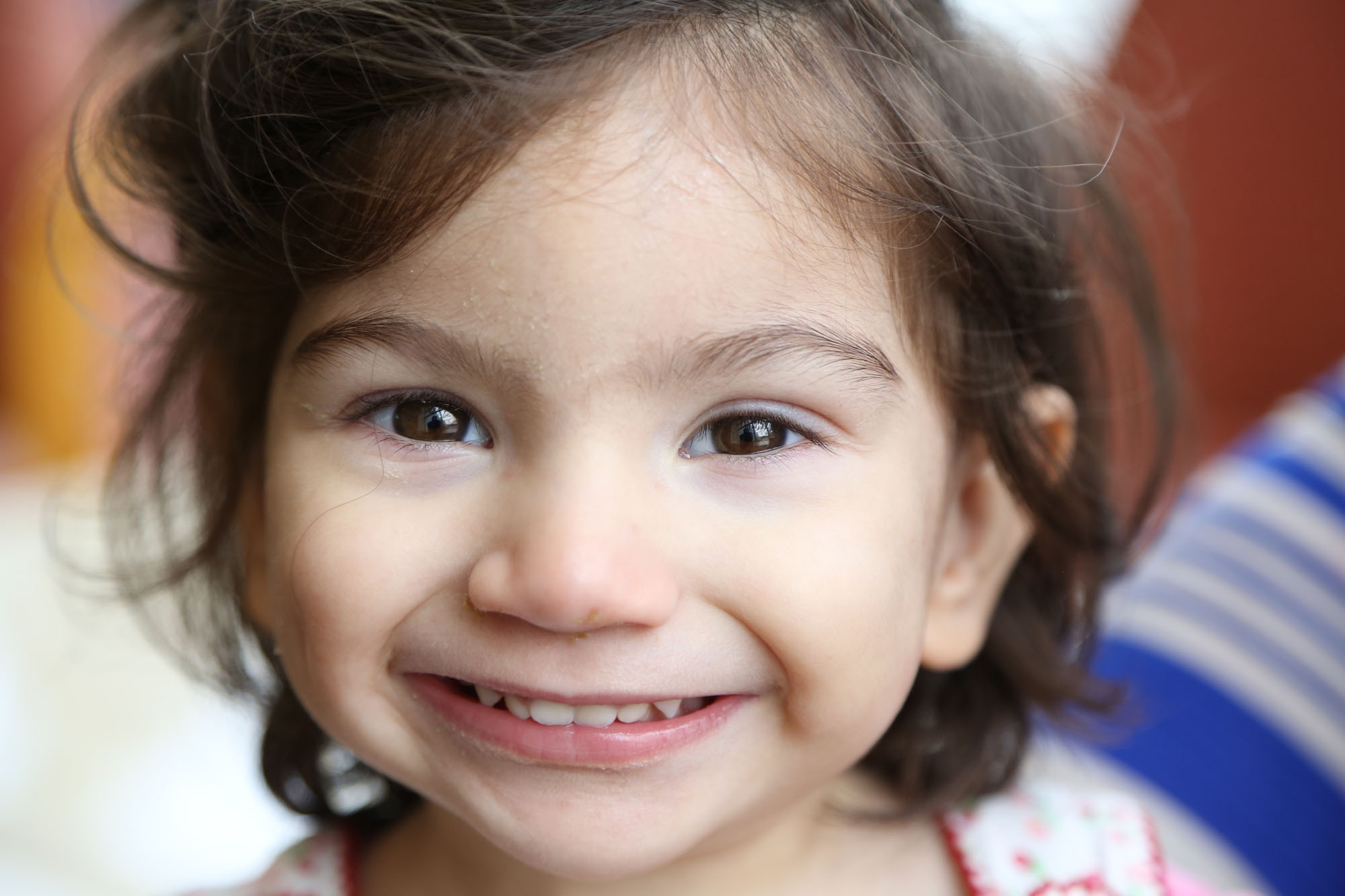 young girl with moebius syndrome smiling