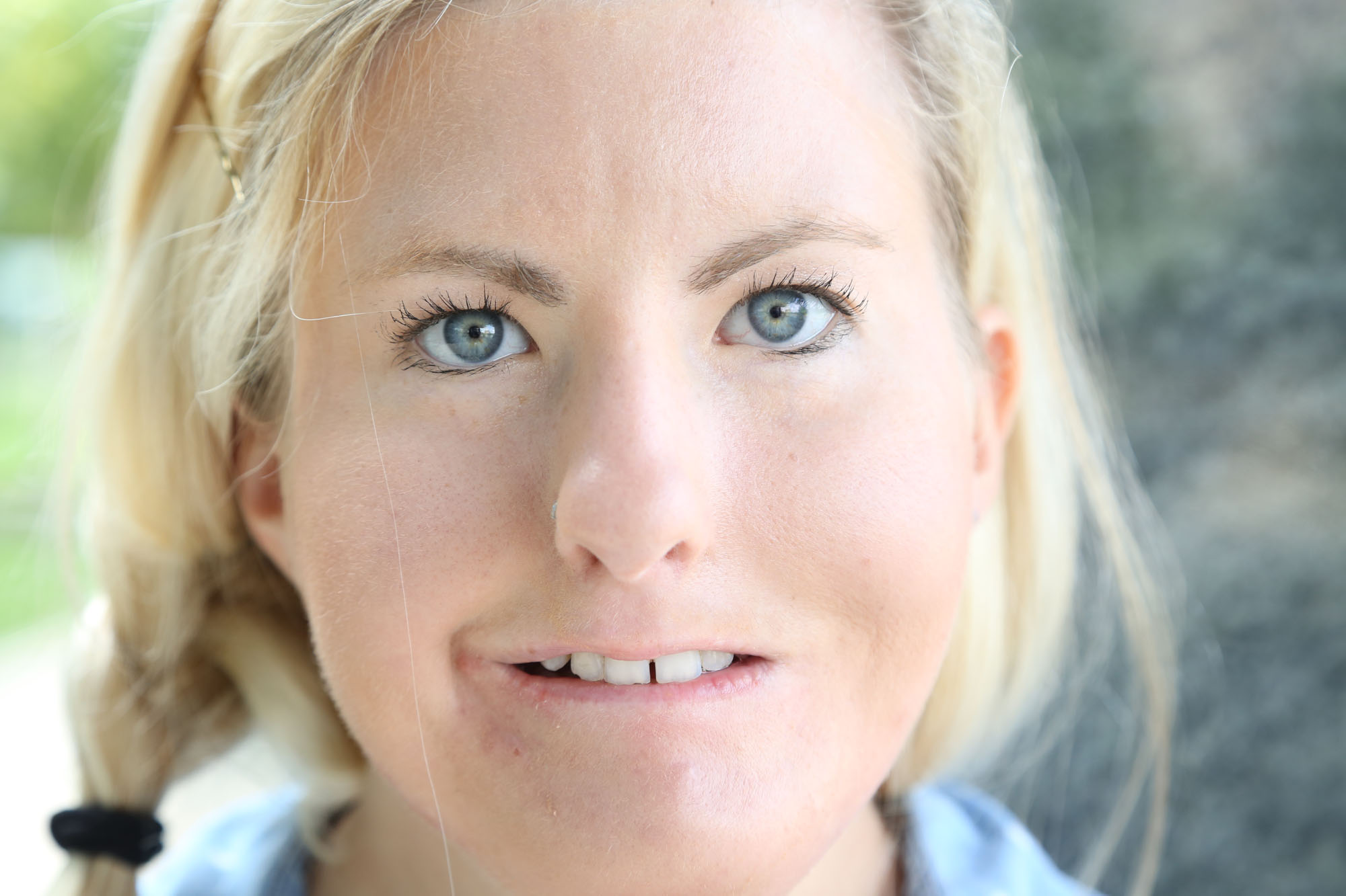 woman with moebius syndrome looks into the camera closeup