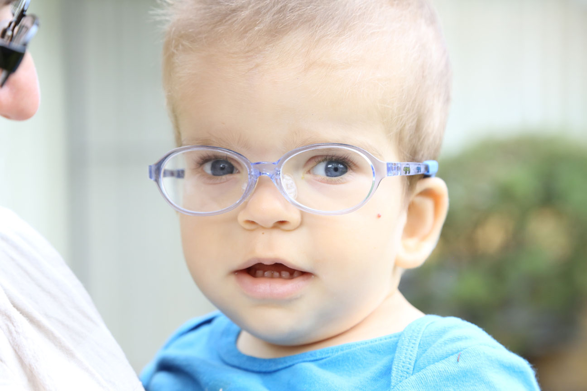 toddler boy with coffin siris syndrome looking at camera