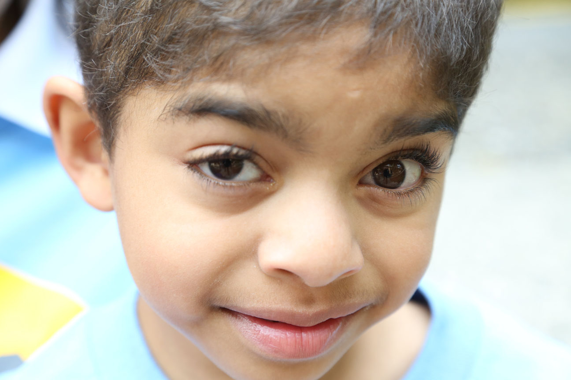 young boy with coffin siris syndrome closeup photo