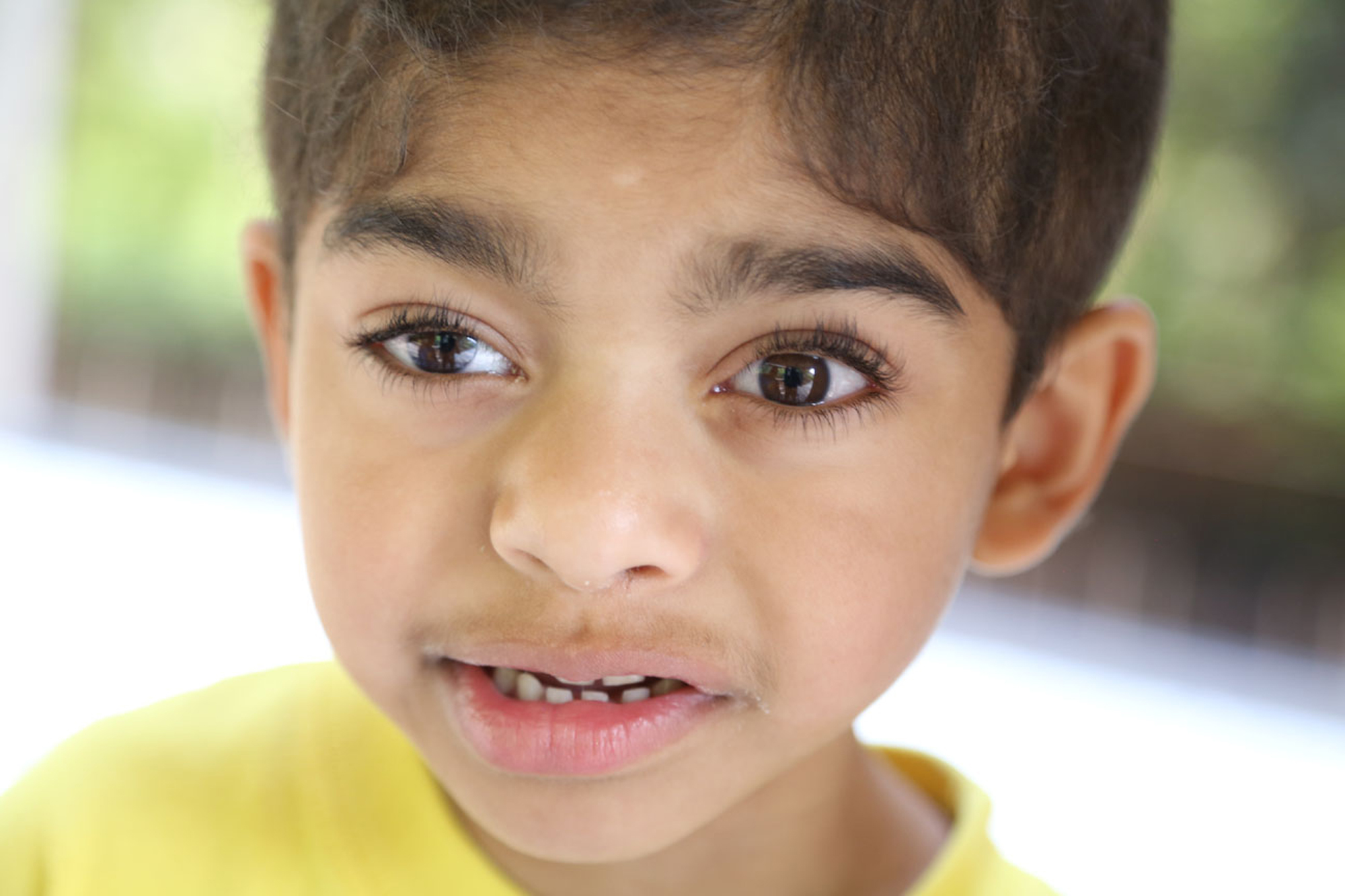 young boy with coffin siris syndrome closeup photo