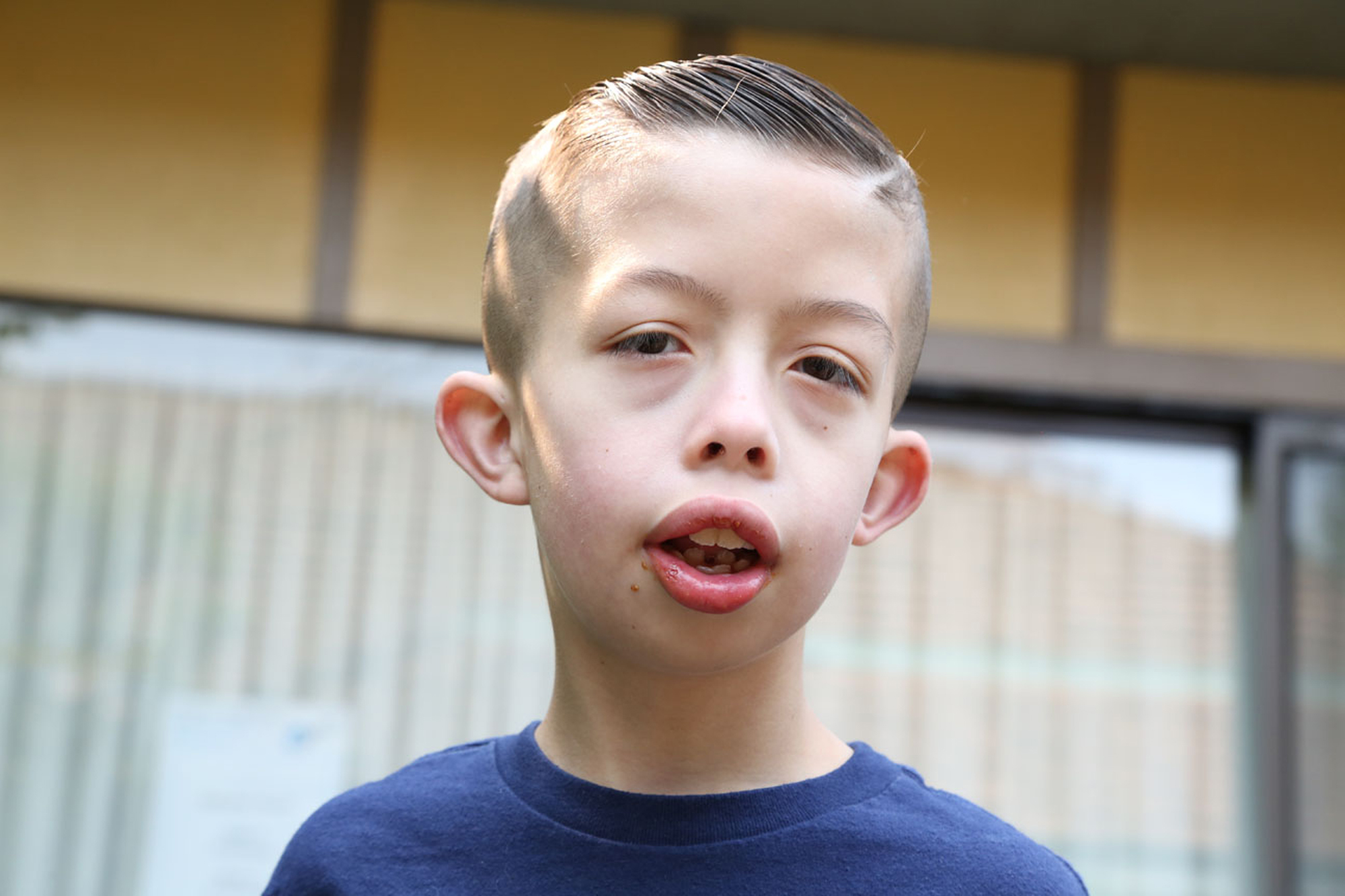 young boy with coffin siris syndrome closeup photo