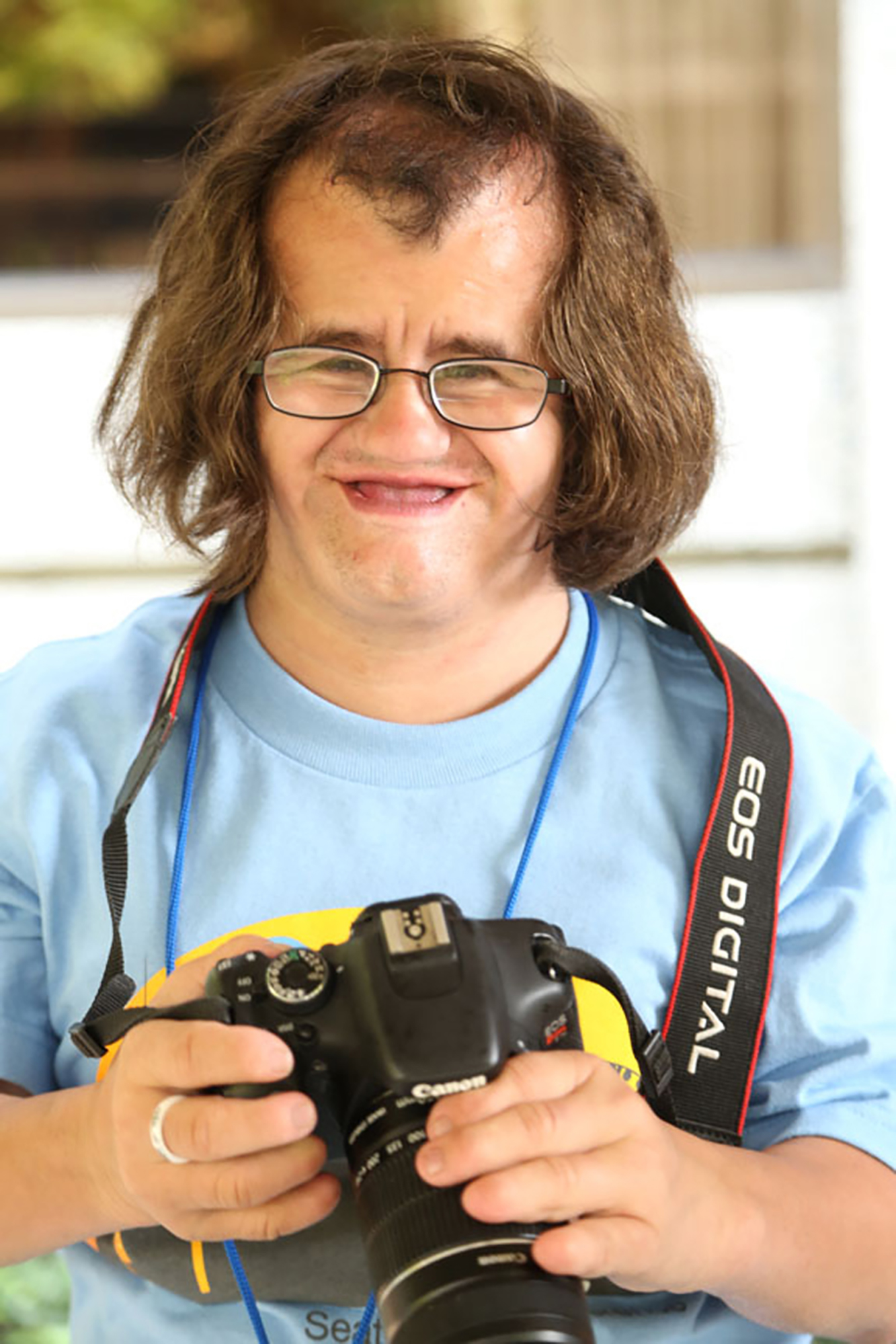 man with coffin siris syndrome wearing blue shirt holding camera