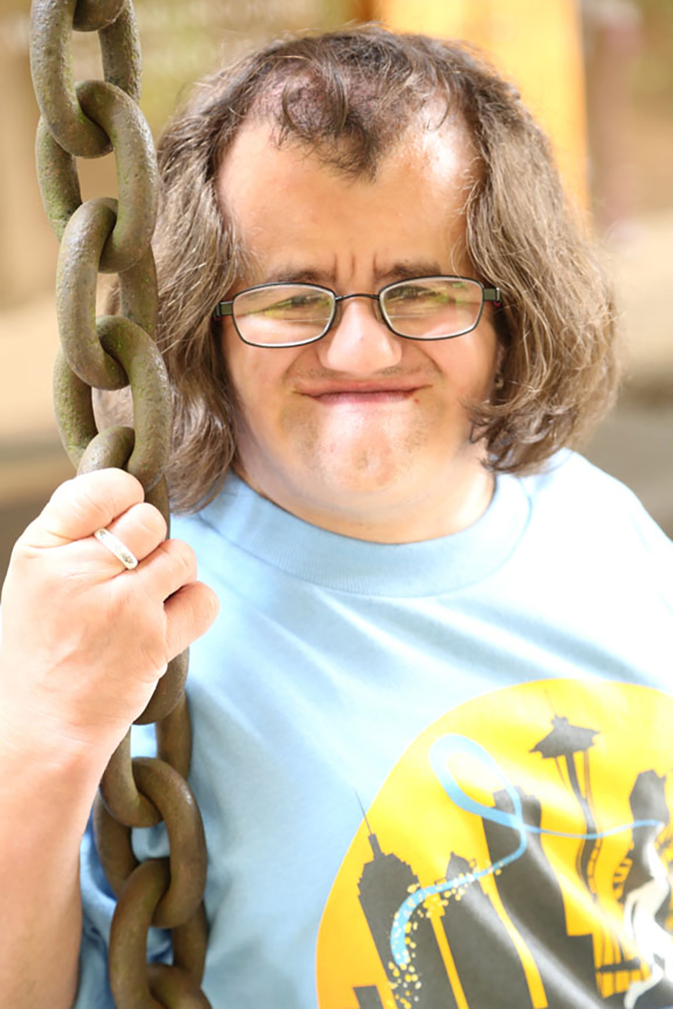 man with coffin siris syndrome wearing blue shirt smiling at camera