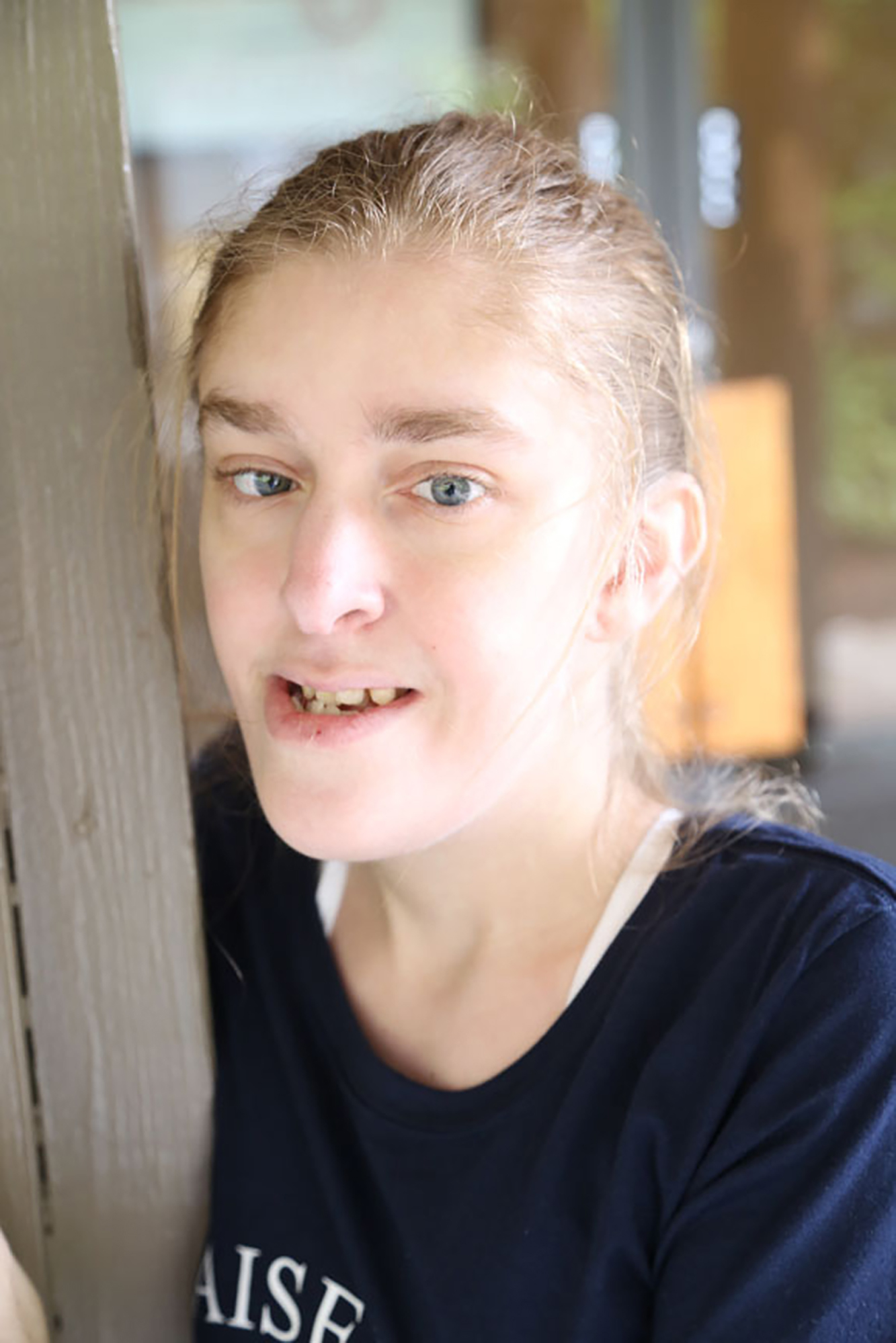 girl with coffin siris syndrome wearing black shirt