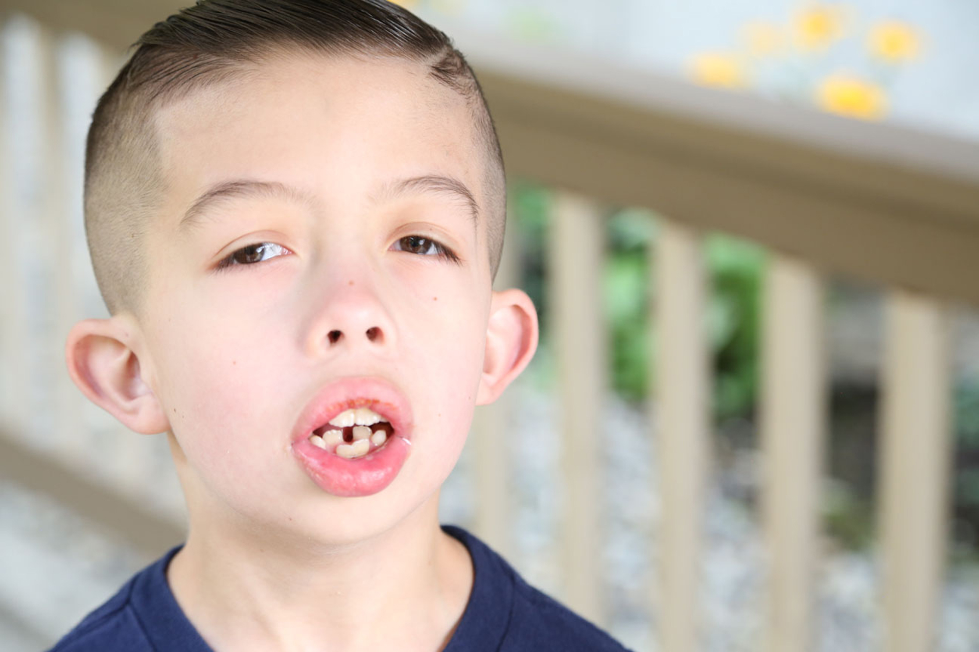 young boy with coffin siris syndrome closeup photo