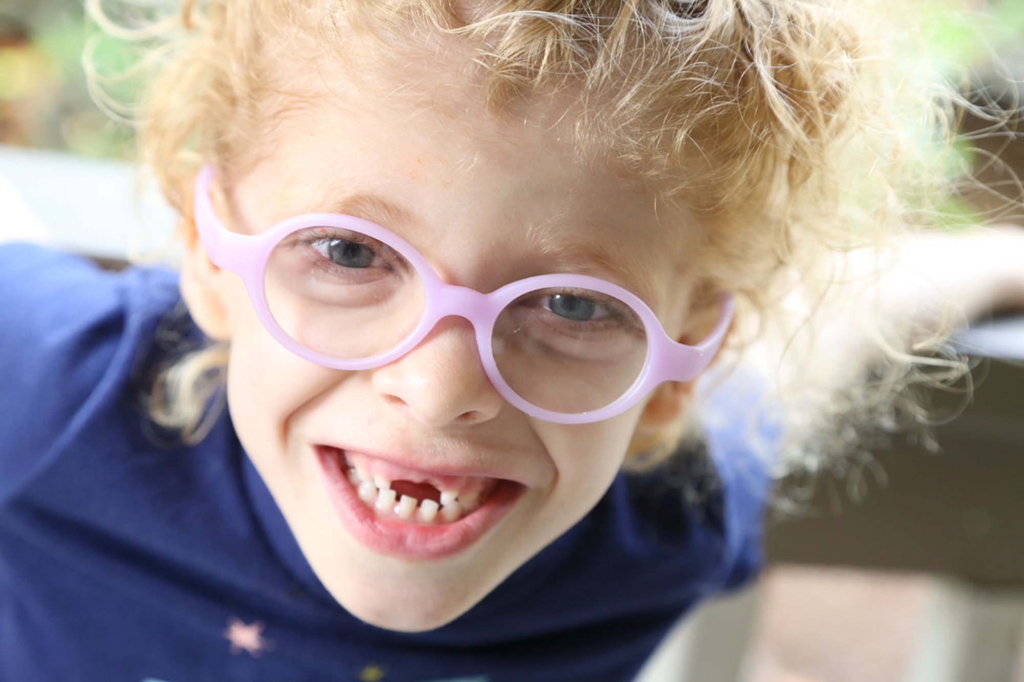 Young girl with coffin siris syndrome wearing pink glasses and smiling