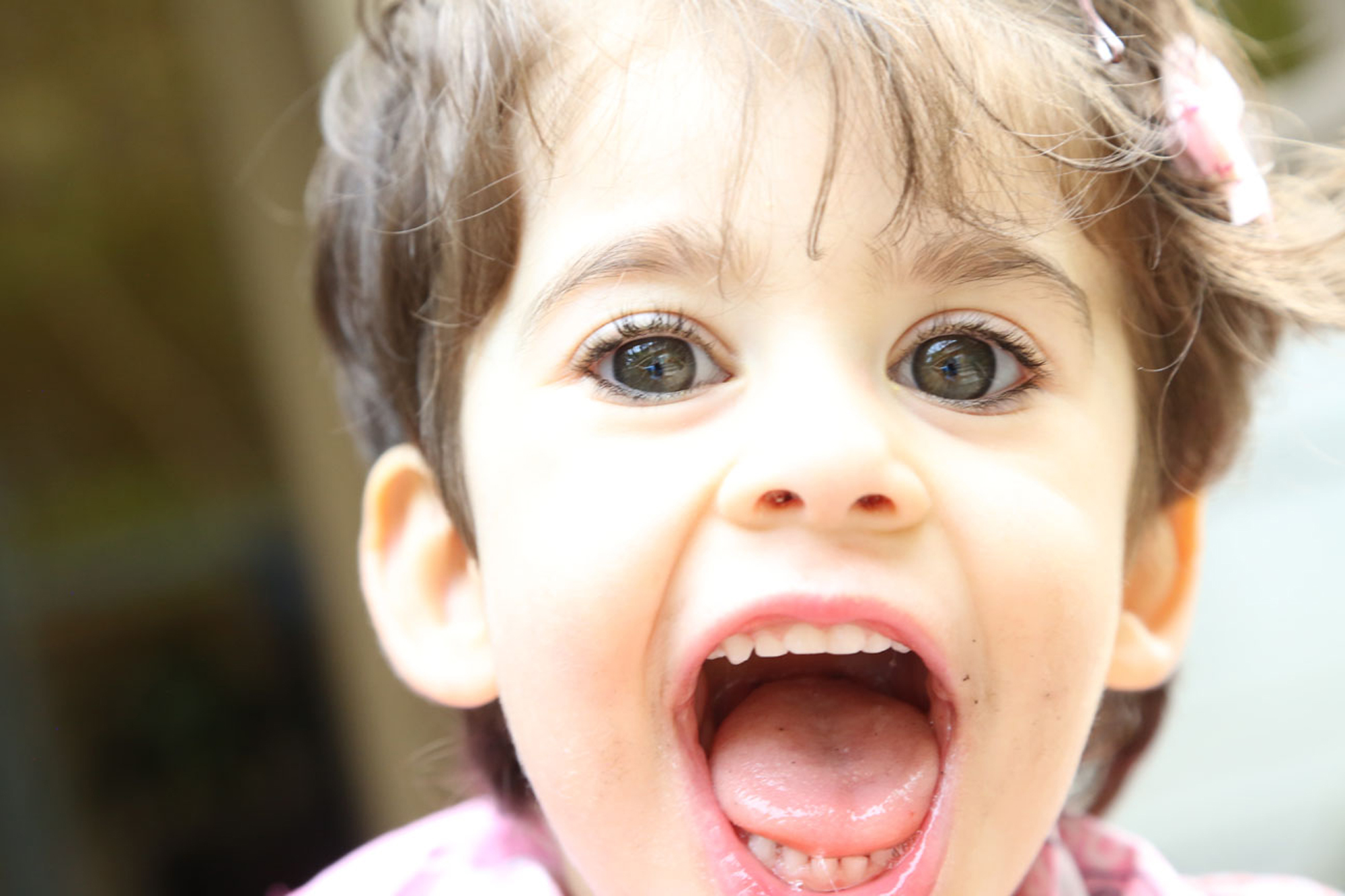 Young girl with Coffin siris syndrome smiling really wide